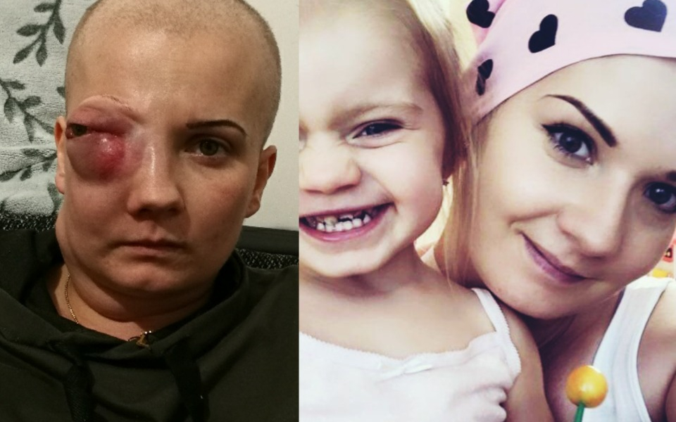 22-letnia mama 2-letniej Kalinki choruje na zdiagnozowany nowotwór złośliwy (mięsakomięśniak prążkowanokomórkowy). Aga apeluje do ludzi dobrej woli o pomoc.